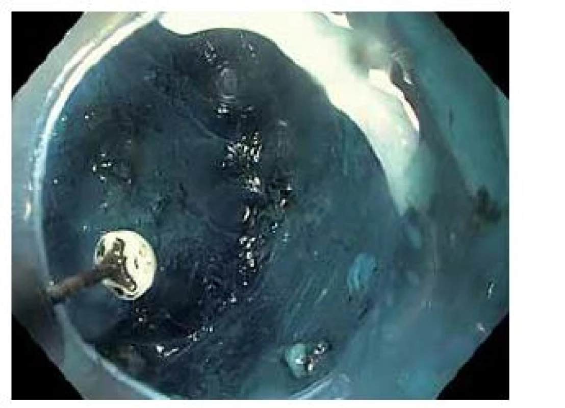 Submukózní disekce. Submukóza zbarvena metylenovou modří.
Fig. 3. Submucosal dissection. Submucosal layer stained by methylen blue.
