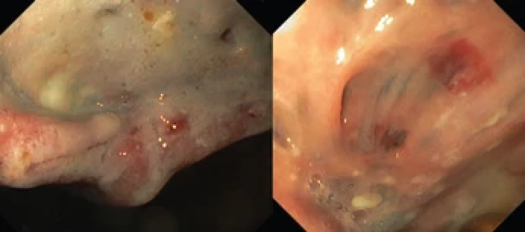 Kalózna ulcerácia pod anastomózou 2 × 3 cm, ústia drobných fistuliek u prvej pacientky.