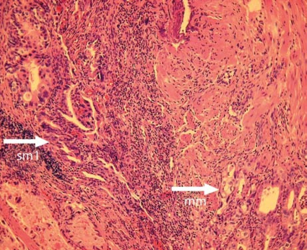 Histologický nález z resekátu s patrnou invazí adenokarcinomu do první třetiny submukózy.
Fig. 3. Histological finding in the tissue specimen obtained by EMR recognizing a submucosal invasion of the adenocarcinoma.
