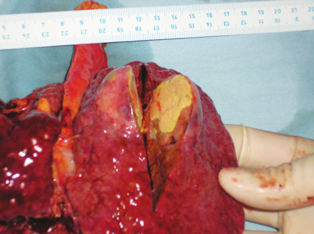 Nekrotický nádor – makroskopie
Fig. 6. The necrotic tumor – macroscopy