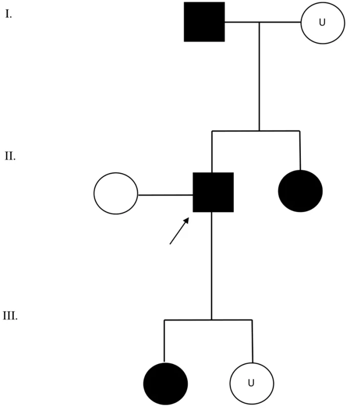 Familial transmission of the heterozygous SGCE variant NM_003919.2(SGCE):c.663-3C>A in individuals with myoclonusdystonia (MD).  black colour – carriers of the heterozygous SGCE variant confirming the clinical diagnosis of MD; white colour – clinically asymptomatic; U – untested