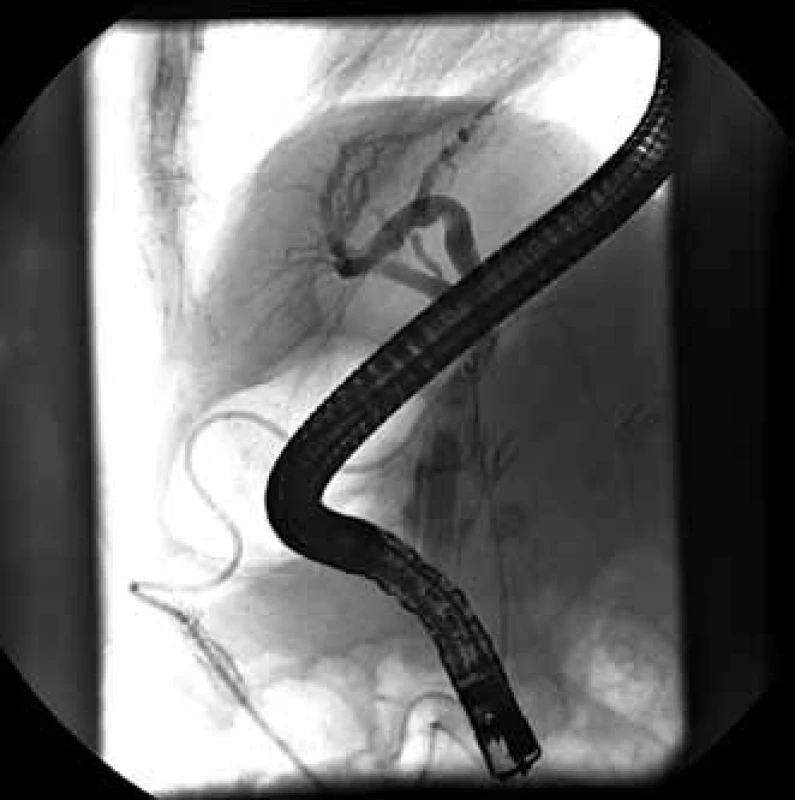 Únik žlče v oblasti proximálnej tretiny hepatocholedochu v úrovni zavedeného T-drénu.
Fig. 3. Bile leak in the proximal third of common bile duct in the level of inserted T-drain.