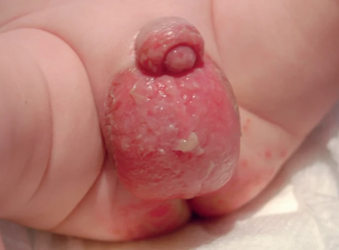 Acrodermatitis enteropathica
