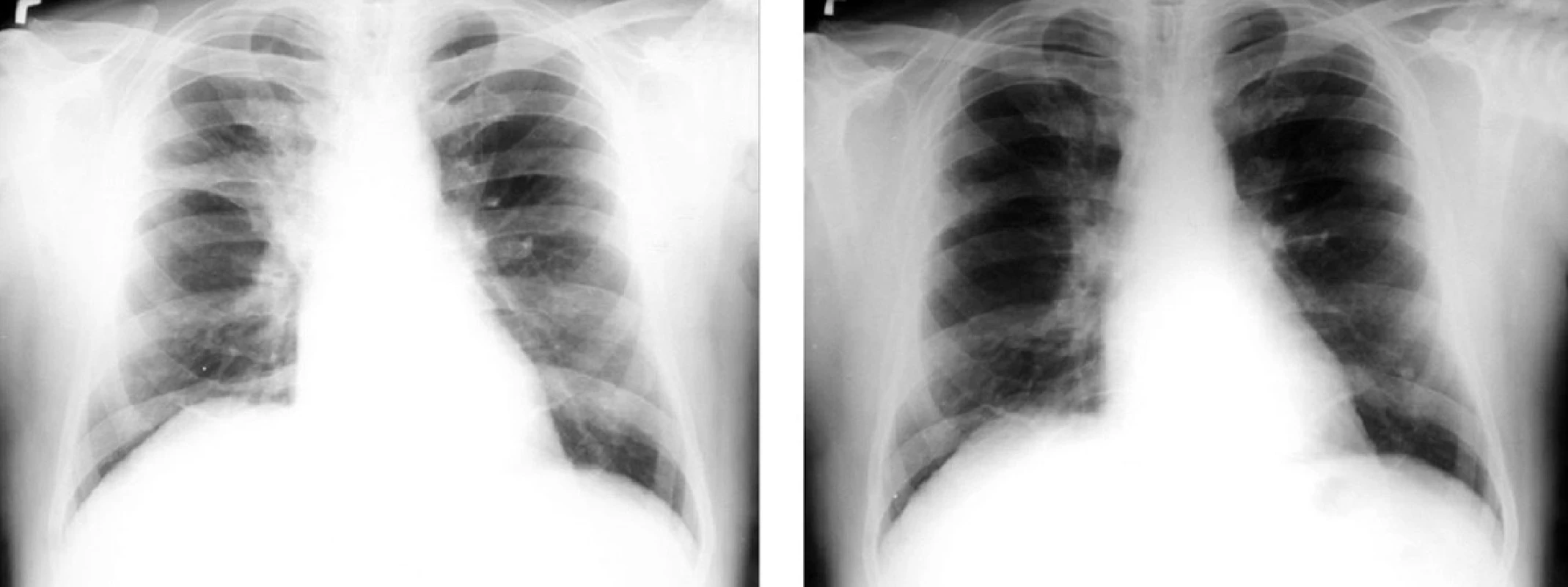 Nemalobuněčný karcinom pravé plíce před léčbou a po léčbě kombinovanou chemoterapií a souběžnou radioterapií