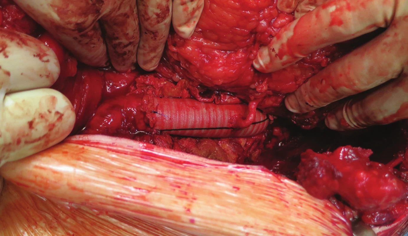 Náhrada s implantací levé renální tepny
Fig. 3: Aortic replacement with left renal artery implantation