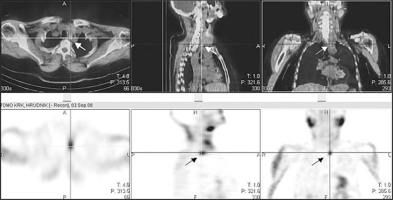 Scintigrafie příštítných tělísek doplněná tomografií krku a hrudníku (SPECT/low dose CT)
Drobné oválné ložisko zvýšené akumulace radiofarmaka (<sup>99m</sup>Tc-MIBI) za dolním polem zvětšeného levého laloku štítnice hluboko prevertebrálně (šipka)