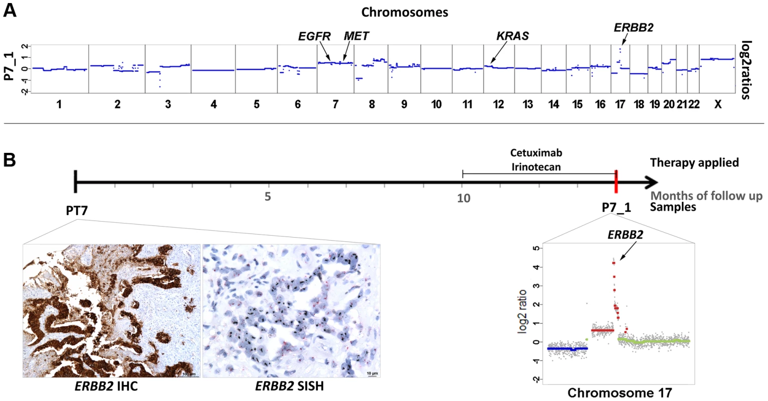 High-level focal amplification of <i>ERBB2</i> in patient #7 treated with cetuximab.