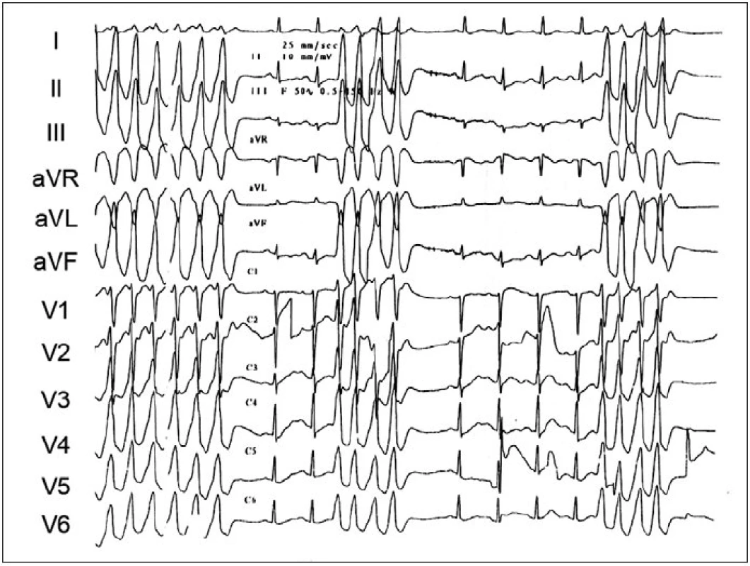 Ukázka repetitivních běhů idiopatické KT. V EKG-obrazu je patrna přechodní zóna ve V<sub>2</sub> s úplnou pozitivitou QRS ve svodu V<sub>3</sub>. Arytmie pocházela z fokusu přístupného z kapsičky pulmonální chlopně.