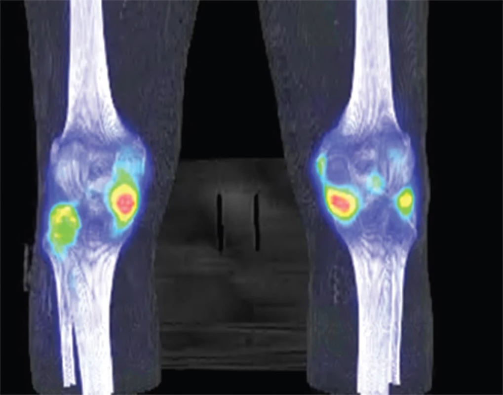 Fúze MIP SPECT/CT kolenních kloubů v pozdní fázi – zvýšená akumulace radiofarmaka především v mediální části obou kolenních kloubů s korelátem degenerativních změn.