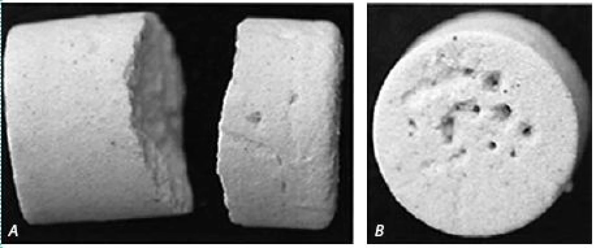 Účinky rázové vlny na umělém konkrementu (in vitro test)
A – následek obvodového sevření; B – následek kavitace
Fig. 11 Artificial stone showing damage characteristics of two mechanisms of shock wave action
A – failure caused by spallation; B – effect of the cavitation forces