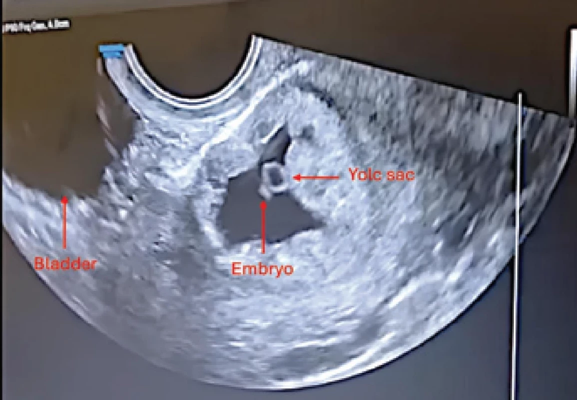 Transvaginal ultrasound showing a gestational sac adjacent to the previous cesarean section scar, with crown–rump length measurement and fetal cardiac activity, consistent with a partial molar pregnancy.
Obr. 1. Transvaginální ultrazvuk zobrazující gestační váček sousedící s jizvou po předchozím císařském řezu s měřením délky temeno–kostrč a srdeční aktivitou plodu, což odpovídá částečné molární graviditě.