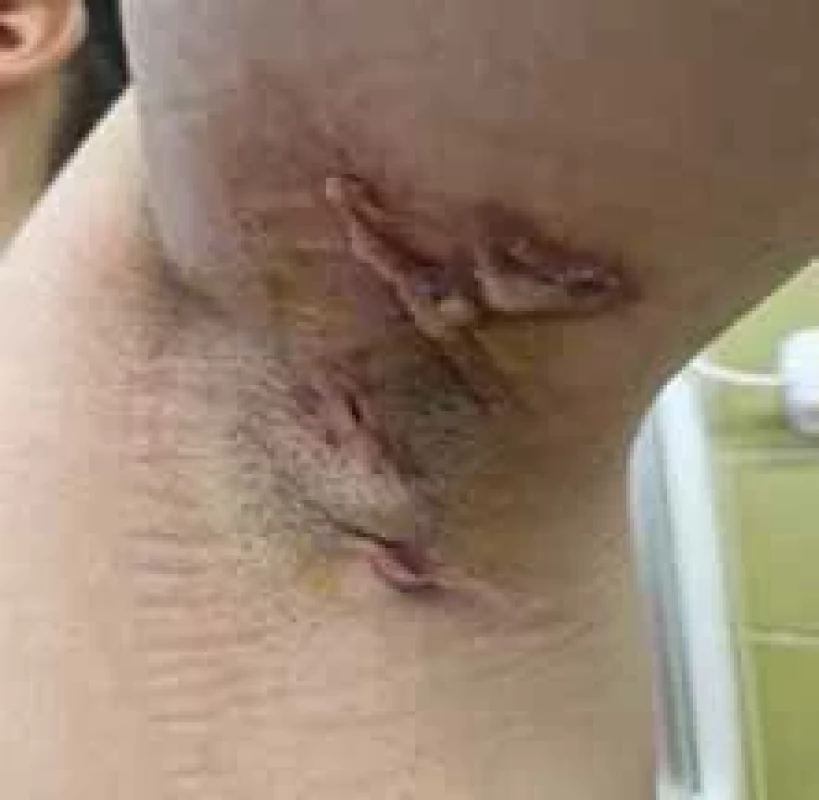 Axilárne postihnutie pri HS. //  Axillary involvement in HS.