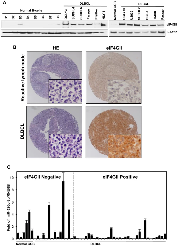 DLBCL cells express high levels of eIF4GII protein and low levels of miR-520c-3p.