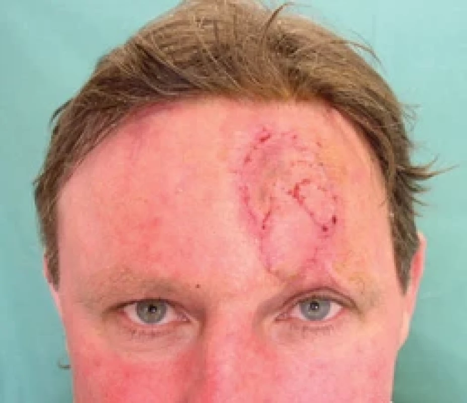 Healed, stitches removed. Source: archive of authors.