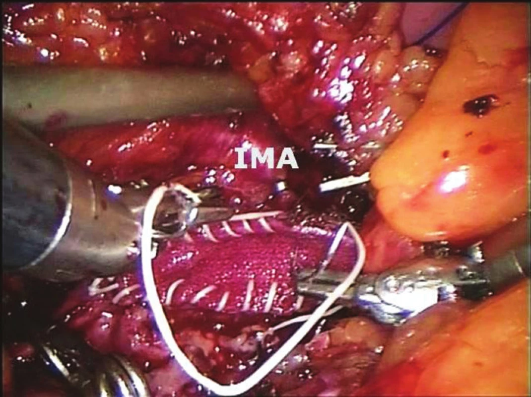 Tromboendarterektomie aorty se záplatou (IMA – arteria mesenterica inferior)
Fig. 2: Aortic thromboendarterectomy with prothetic patch (IMA – inferior mesenteric artery)