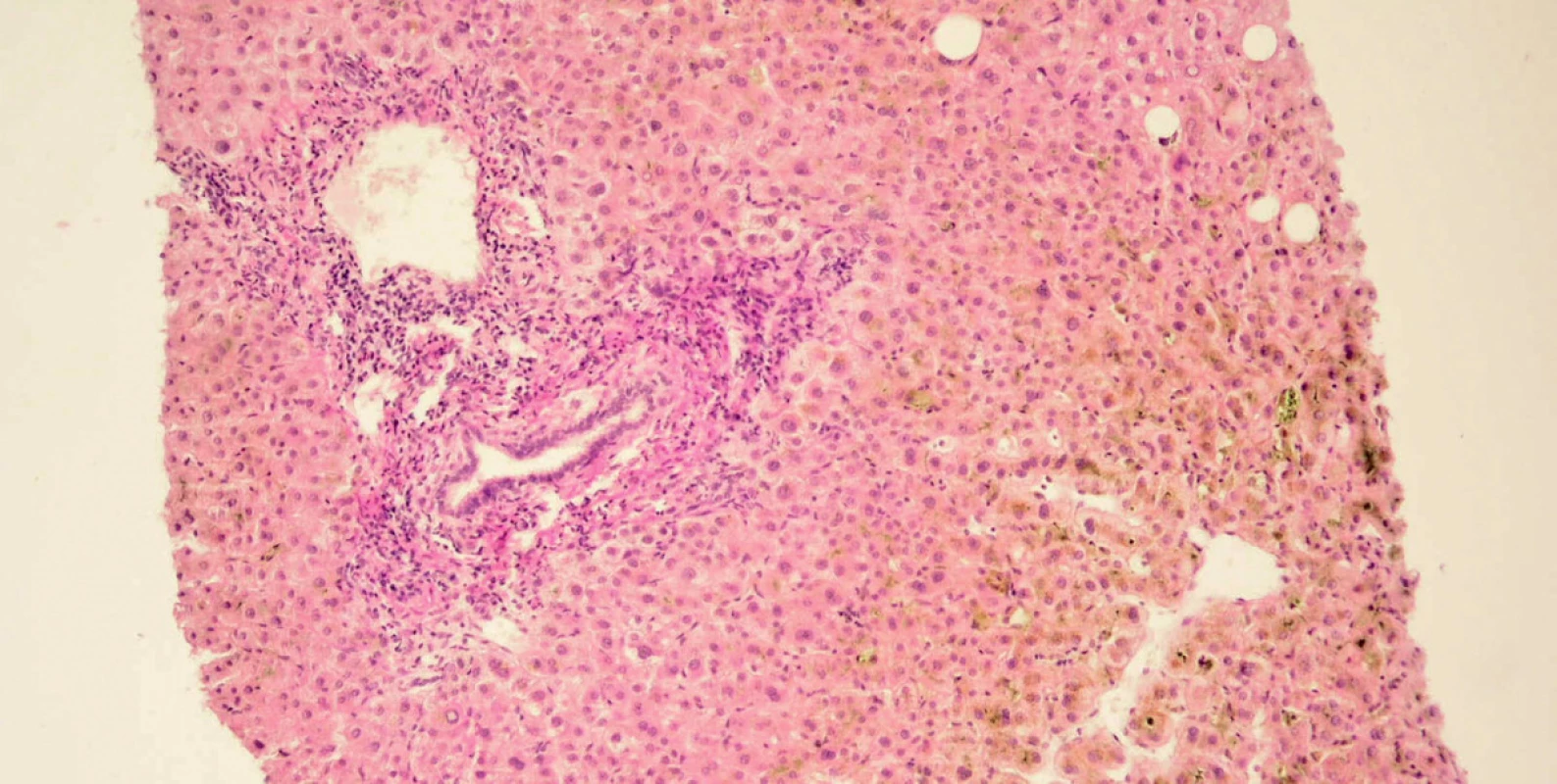 Mikroskopický obraz biopsie jater. Cholestatická hepatitida s částečnou destrukcí stěny portálních žlučovodů