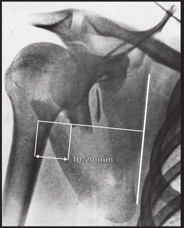 Měření dislokace úlomků laterálního okraje těla lopatky: a – angulace; b – translace; 
c – medio-laterální posun.
Fig. 5: Measuring of displacement of fragments of lateral border of scapular body: a – angulation; 
b – translation; c – medio-lateral displacement.