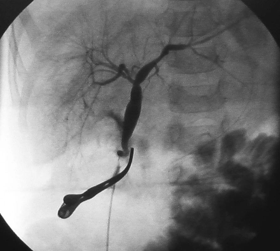 Peroperačná cholangiografia s dilatáciou intrahepatálnych
žlčovodov
Fig. 5. Peroperative cholangiography shows dilatation of intrahepatic
ducts