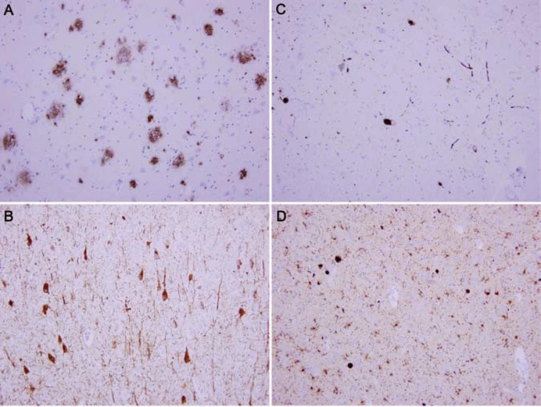 Neuropatologický obraz vyšetření mozkové tkáně.