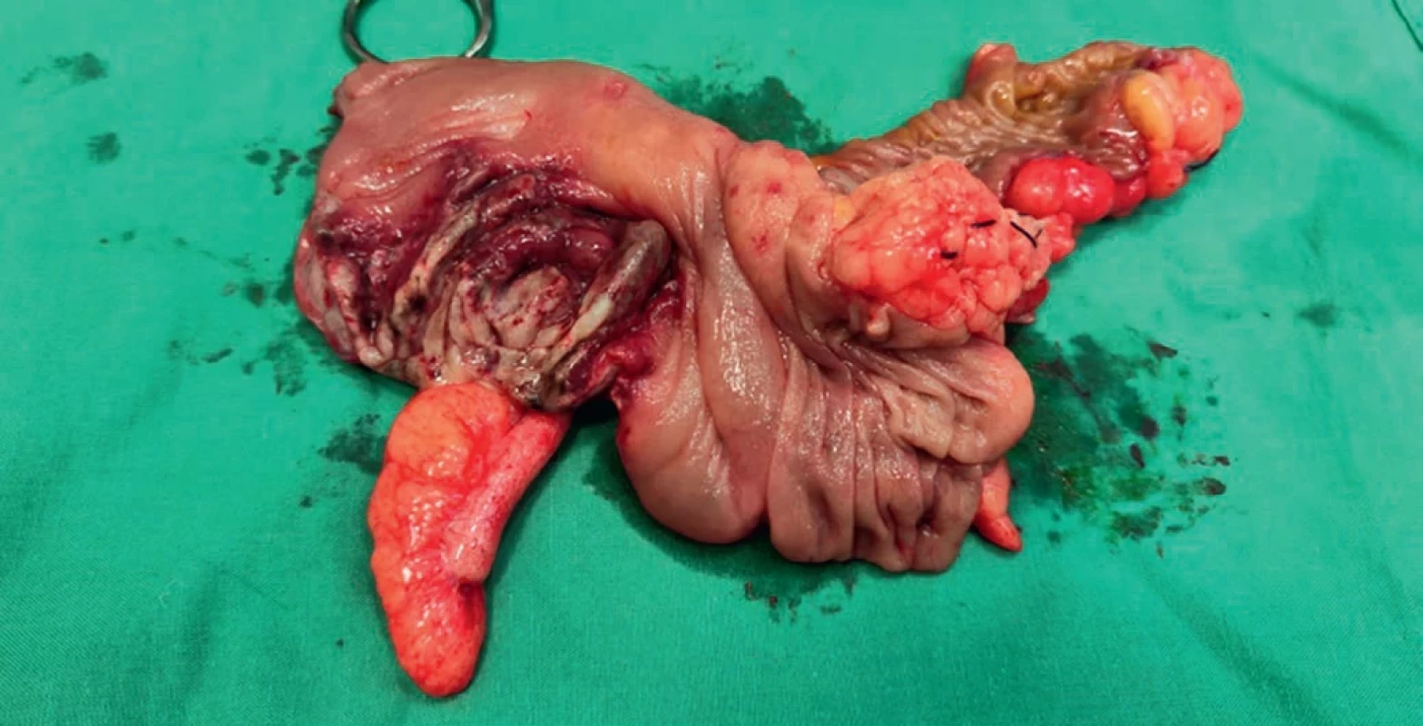 Resekát po rozstřižení, viditelný fyziologický apendix se zbytnělým mezenteriolem. Resected tissue after cut open, a clearly physiologic appendix with oedematous mesenteriolum.