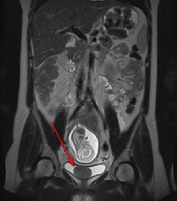 MR, koronární řez, T2 vážený obraz: homogenní, ohraničený, hladký, kulovitý útvar
v močovém měchýři
Fig. 1. MR scan, coronal section, T2 weighted image: homogenous, smoothly marginated mass in the urinary bladder