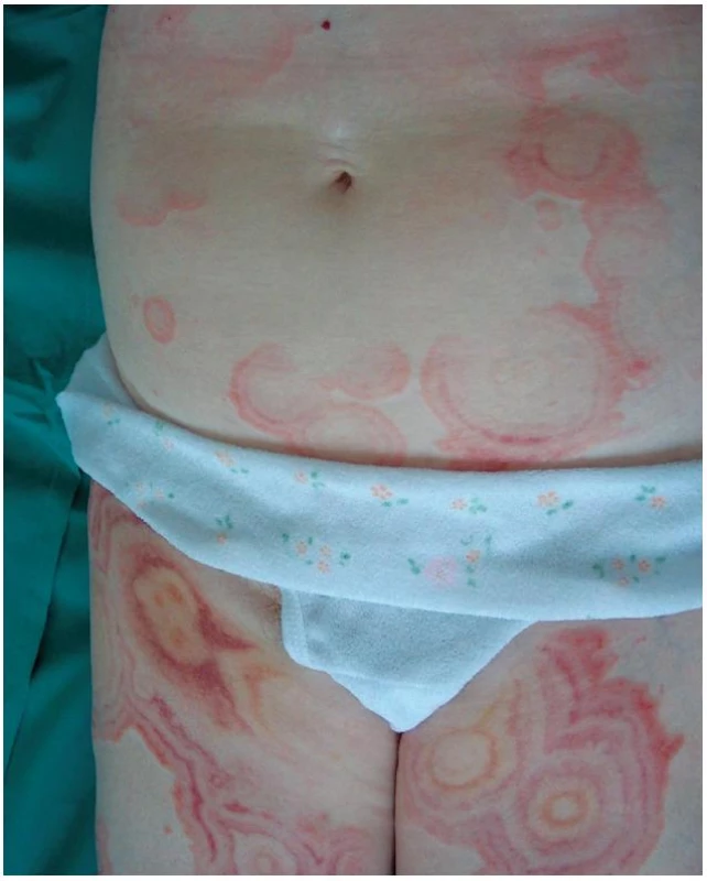 Erythema gyratum repens