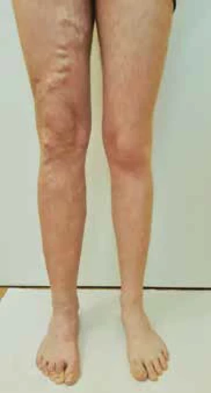 Klinický nález KTS u pacienta z první kazuistiky