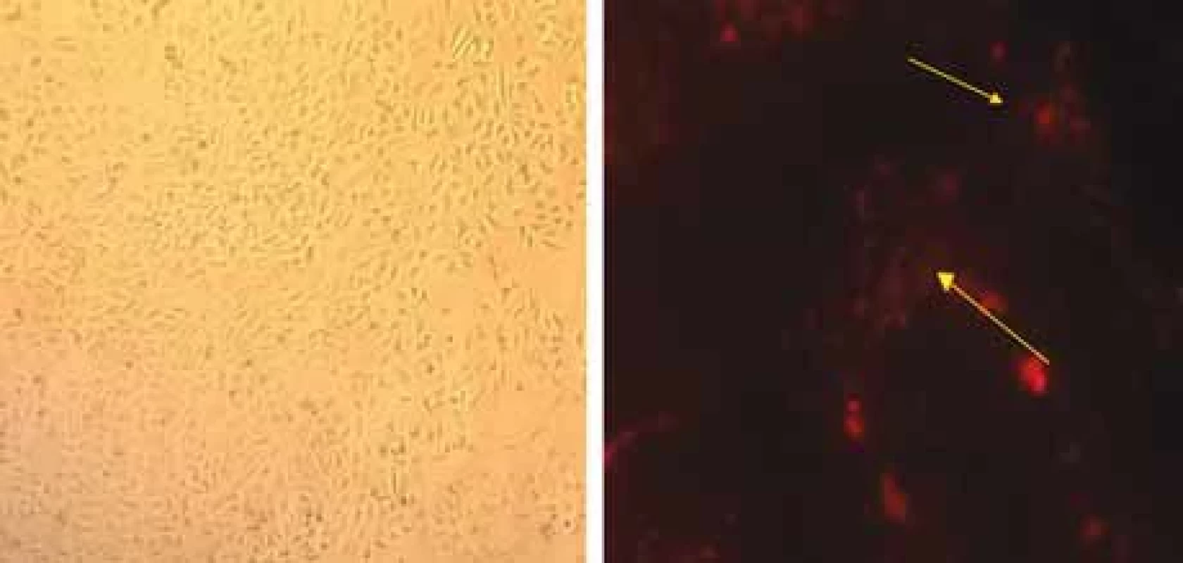 A) HUVEC endothelial cell line (magnifi cation 90×); B) locating PKH26-labeled tumor exosomes in the cytoplasm of endothelial cells.