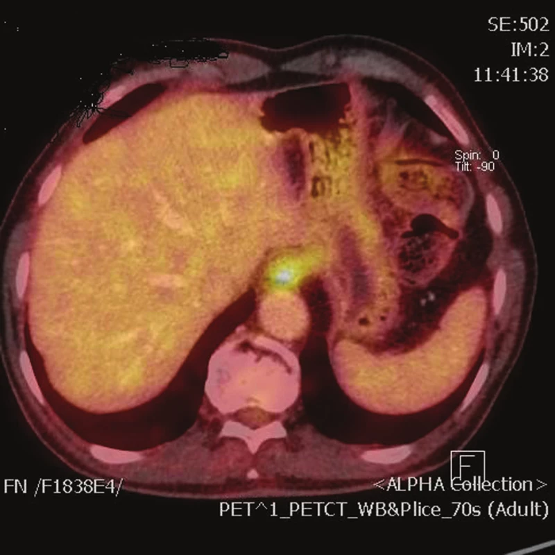 Obraz tumoru kardie na PET/CT
Fig. 1: PET/CT scan of tumor of the gastroesophageal junction