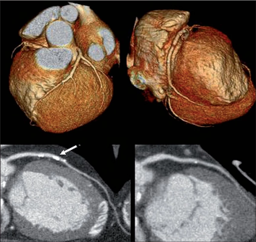 CT kontrastní angiografie – v horní části obrázku trojrozměrné zobrazení koronárních tepen získané na základě náplně tepen a srdečních struktur kontrastní látkou. V dolní části obrázku dvojrozměrné zobrazení koronárních tepen vhodné k posouzení stupně obstrukce tepen. šipka
ukazuje na místo s kalcifikací ve stěně tepny, kde se nelze jednoznačně vyjádřit ke stupni
obstrukce.