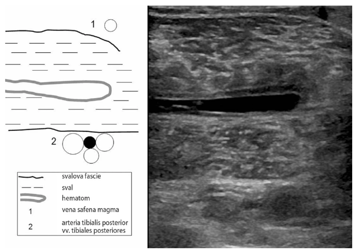Krvácení do m. gastrocnemius medialis a trombóza vv. tibiales posteriores