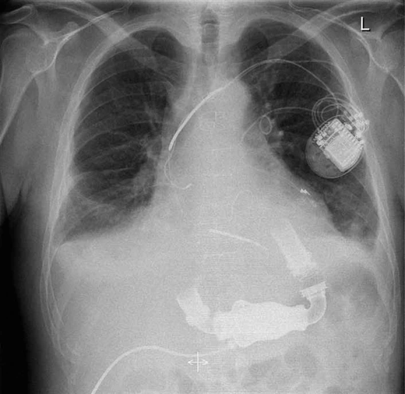 Rentgenový snímek hrudníku pacienta s implantovaným HeartMate II<sup>®</sup> LVAD a kardiostimulátorem (archiv KC IKEM).