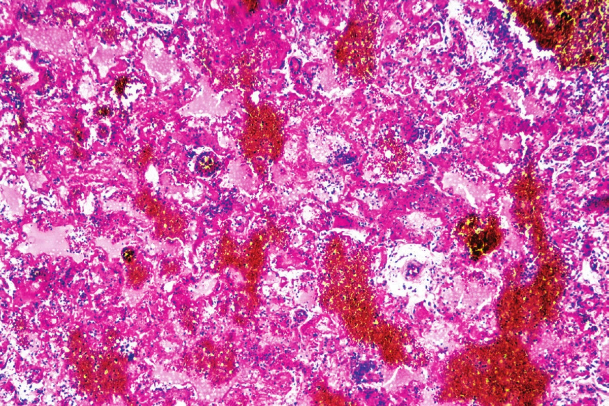 Intraalveolárny edém s recentnými pneumorágiami a hyalínnymi membránami (hematoxylín-eozín, zväčšenie 40x).