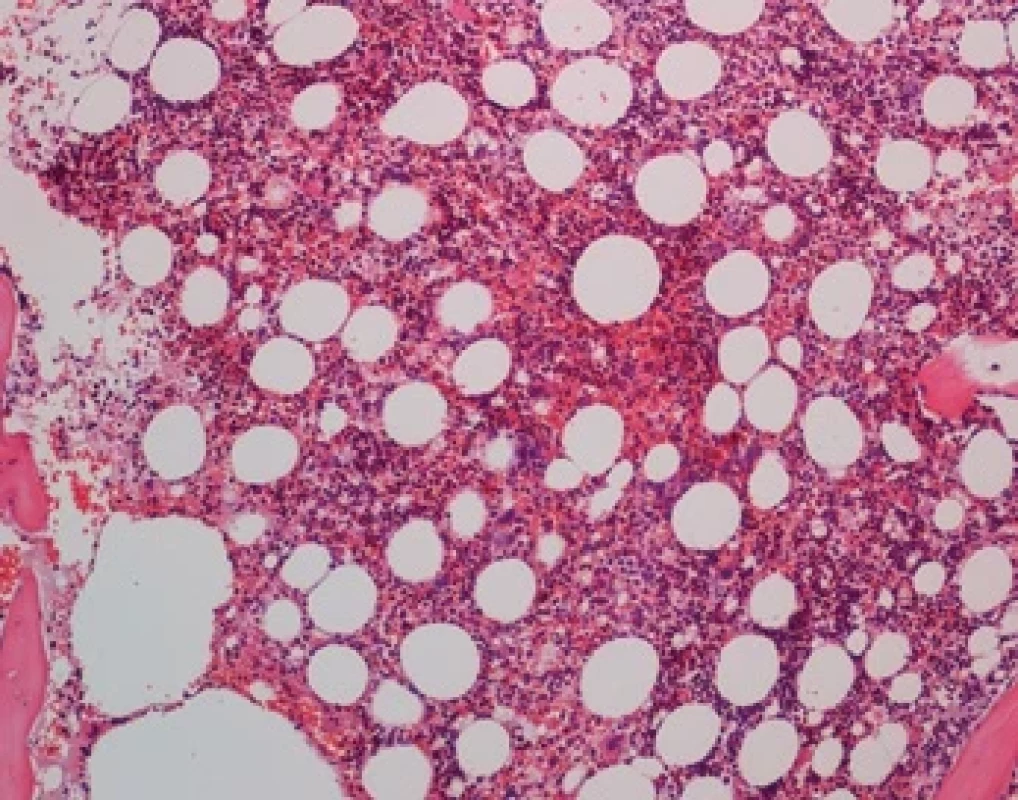 Histologie kostní dřeně po kúře venetoklax + azacitidin (FNHK, Fingerlandův ústav patologie) – trilineární krvetvorba bez dysplastických rysů.