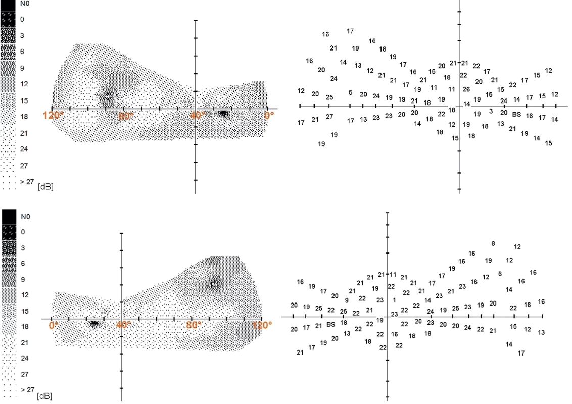 The range of the nasal part of the visual field and the distribution of the examined points. Top – right eye, bottom – left eye