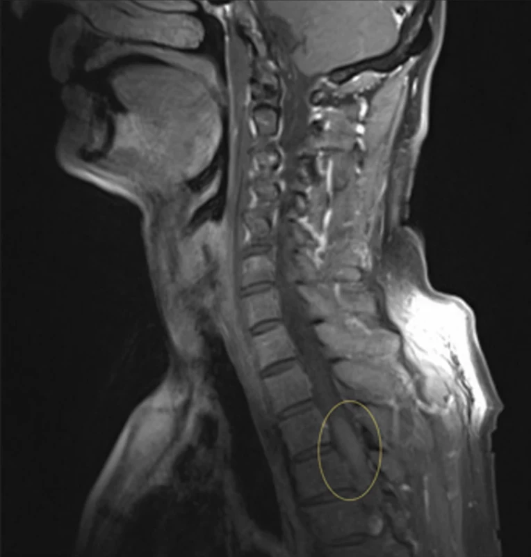  Thoracic lesion on an MRI scan in November 2024.
