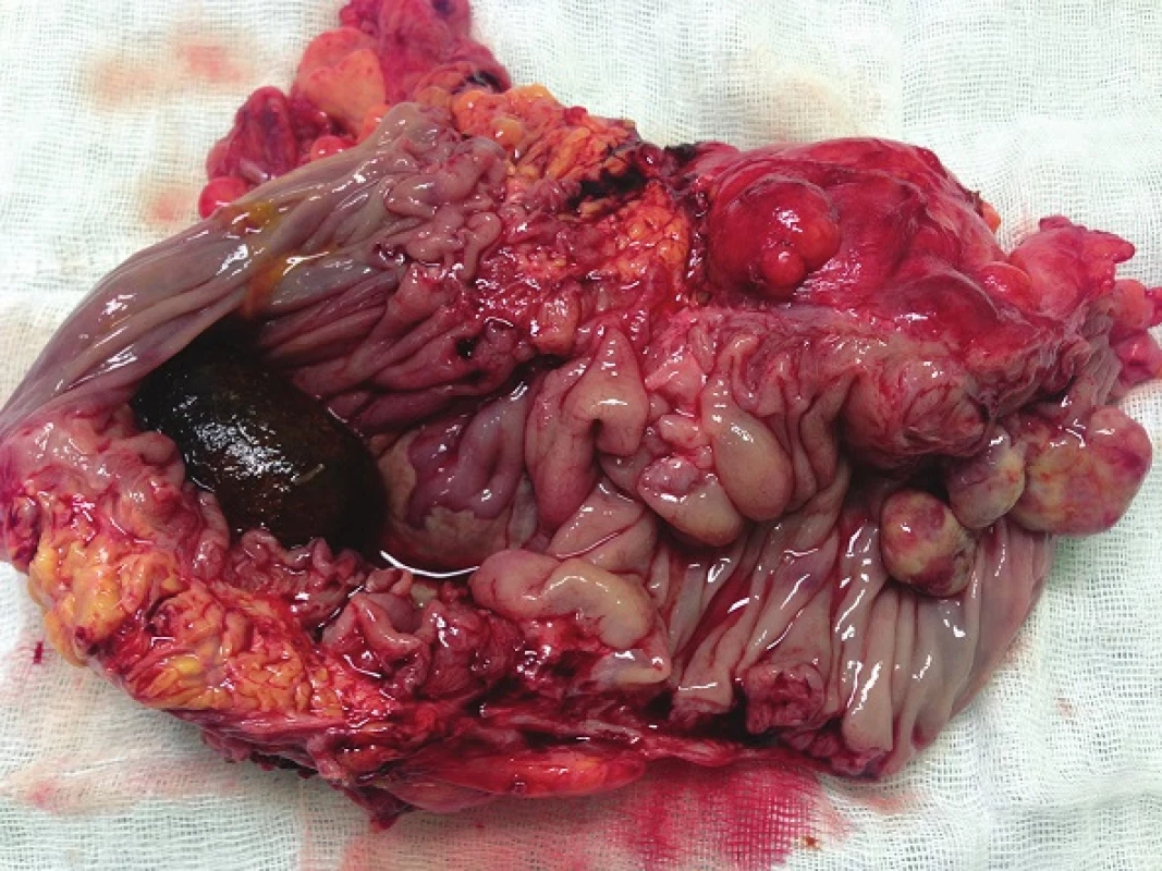 Rozstřižený resekát colon sigmoideum s tumorózním ztluštěním stěny, biliární konkrement obturující lumen
Fig. 5: Resected sigmoid colon with tumorous infiltration of the wall; obstructive gallstone in the lumen