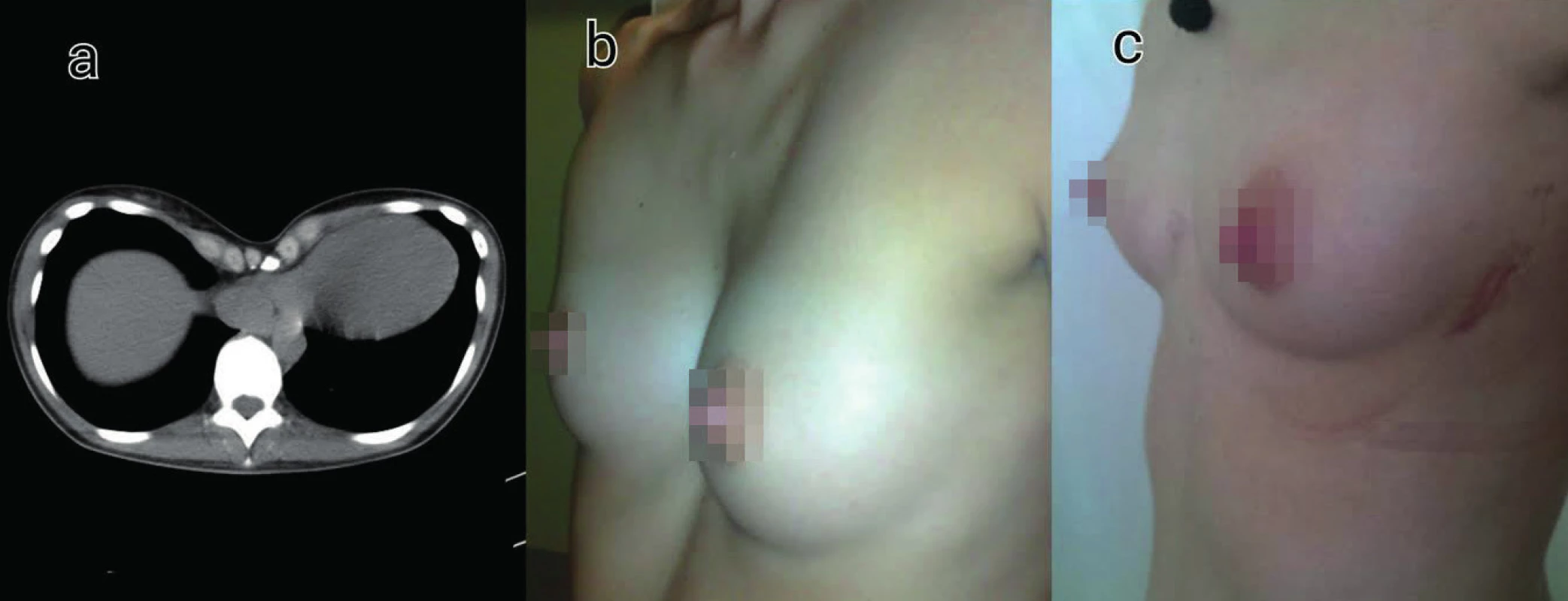 Pacientka s pectus excavatum
a) CT nález
b) Lokálny nález pred korekciou
c) Lokálny nález 12 mesiacov po korekcii
Fig. 1: Female patient with pectus excavatum
a) CT scan of the deformity
b) Clinical picture before MIRPE
c) Clinical picture 12 months after MIRPE