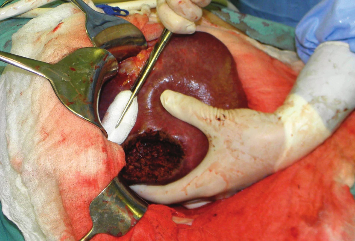 Operační nález: shodný nemocný, pravý lalok jater po neanatomické resekci suspektní metastázy
Fig. 3: Intraoperative finding – right lobe of the liver after non-anatomical resection of metastasis from gastric cancer