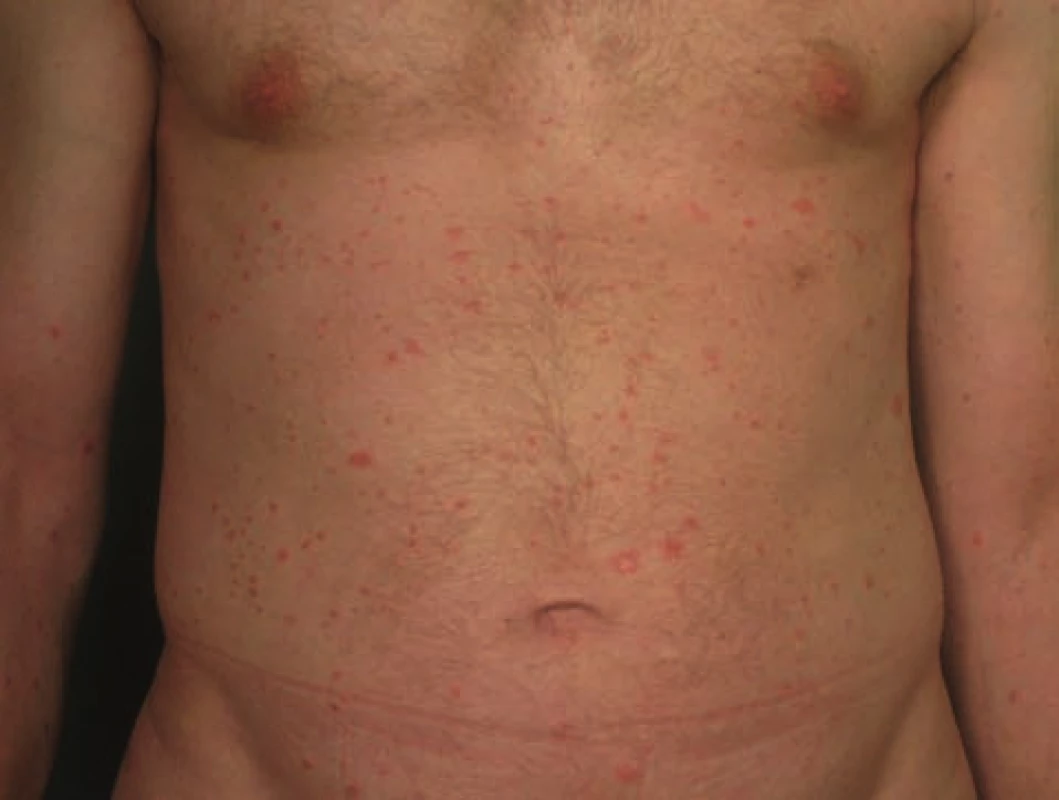 Psoriaziformná kožná erupcia u pacienta so psoriázou počas liečby infliximabom imitujúca psoriasis guttata