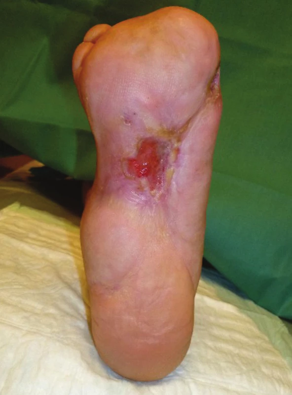 Lokální nález po 11 měsících terapie (současný stav)
Fig. 9: Local finding after 11 months of therapy (current state)