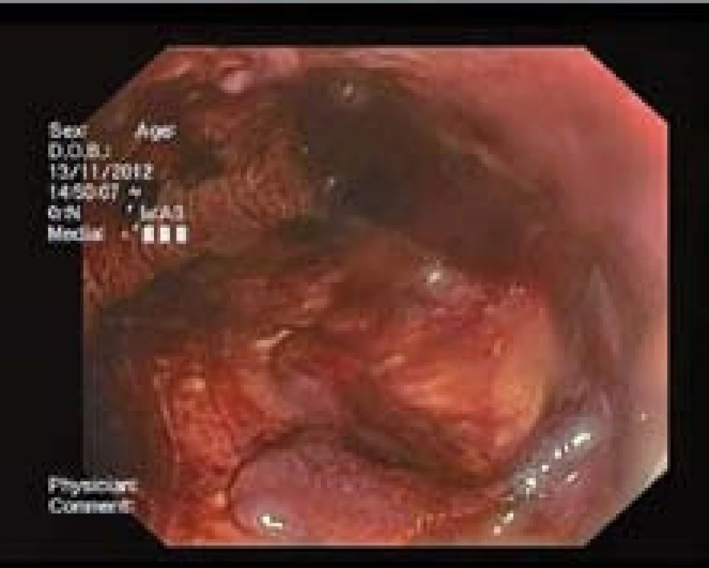 Koagula po zahájení antikoagulační léčby.
Fig. 2. Blood clot in intestine lumen ­after coagulation therapy initiation.
