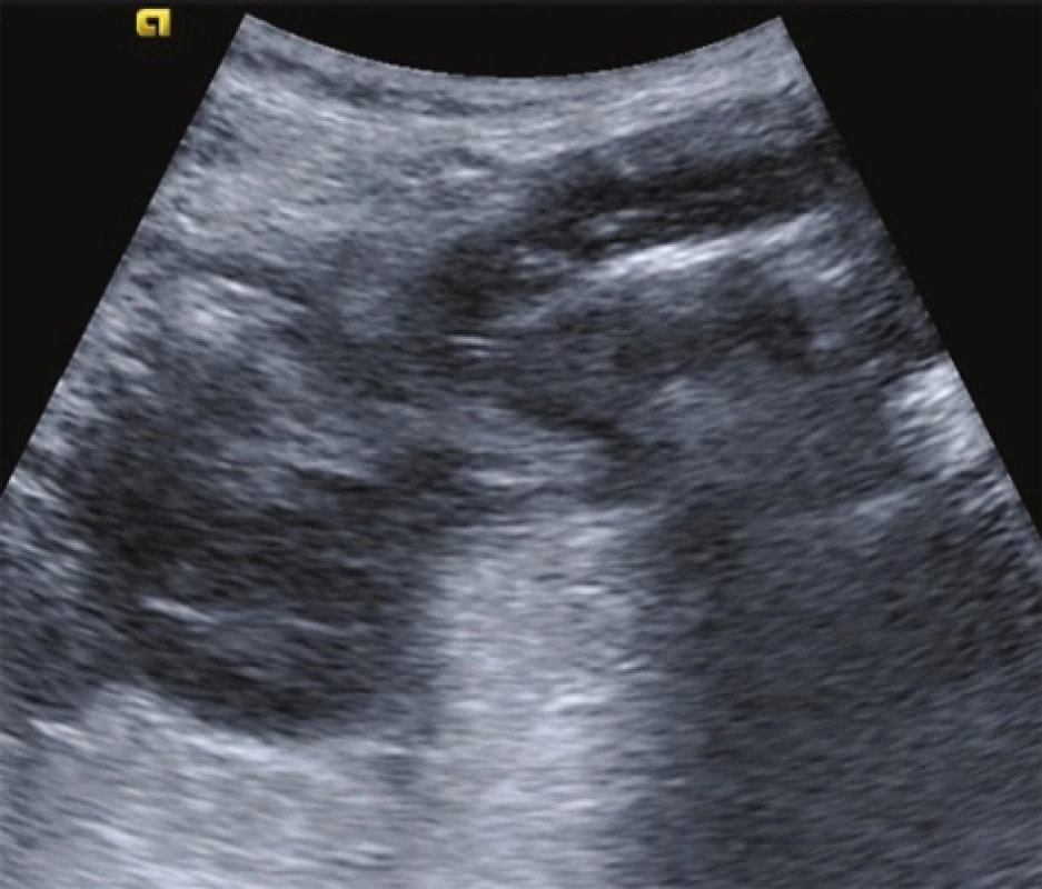 Sonografický obraz zesílení střevní stěny s divertiklem
Fig. 1: Thickened bowel wall with a diverticulum (sonography finding)