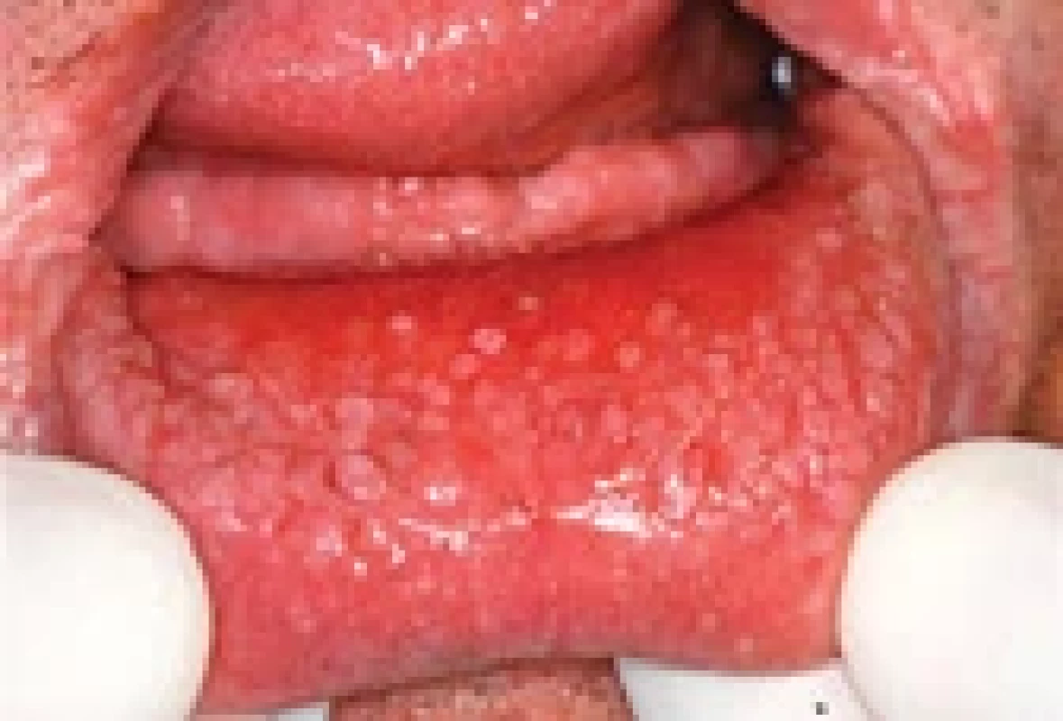 Slizniční léze v dutině ústní. Fig. 2. Mucosal lesions in the oral cavity.
