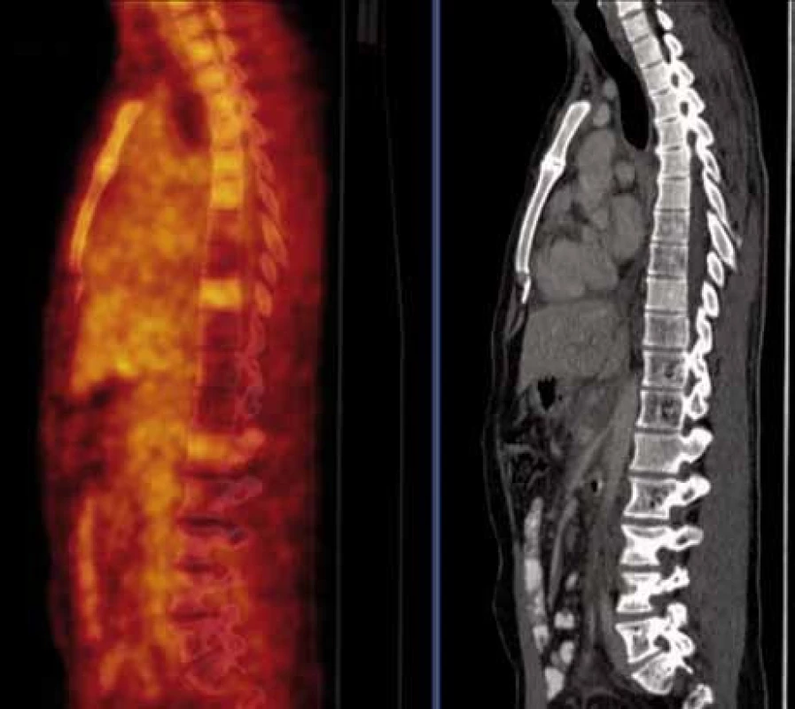 PET/CT vyšetření s podáním i.v. kontrastu provedené v září 2010. Jsou patrny četné hemagiomy patrné v obratlích Th (Th7,8 a Th10-12) a LS (L4-S1) páteře a levé kosti kyčelní, v těchto místech detekujeme sníženou metabolickou aktivitu, která nedosahuje ani fyziologické aktivity v okolních nepostižených obratlích (obr. 18).