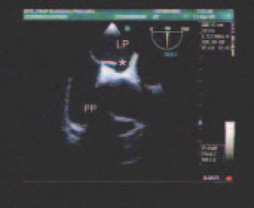 Foramen ovale patens (*) zobrazené ako štrbinovitý kanál medzi pravou predsieňou (PP) a ľavou predsieňou (LP).