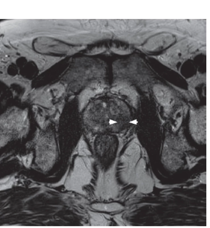 3T MRI prostaty T2 vážený obraz – nález tumoru v levé periferní zóně (hypointenzní oblast) 
Fig. 1. T2 weighted 3T MRI – tumor focus in the left peripheral zone (hypo-intense region)