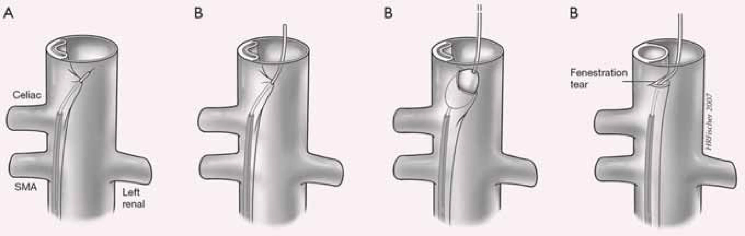 Fenestrace intimal flap. Z pozice utlačeného pravého kanálu je transeptální jehlou propíchnut pod skiagrafickou či IVUS kontrolou intimal flap se zavedením intervenčního vodiče, po kterém je zaveden do oblasti fenestrace balonkový katetr s vytvořením dostatečné komunikace mezi pravým 
a falešným kanálem.