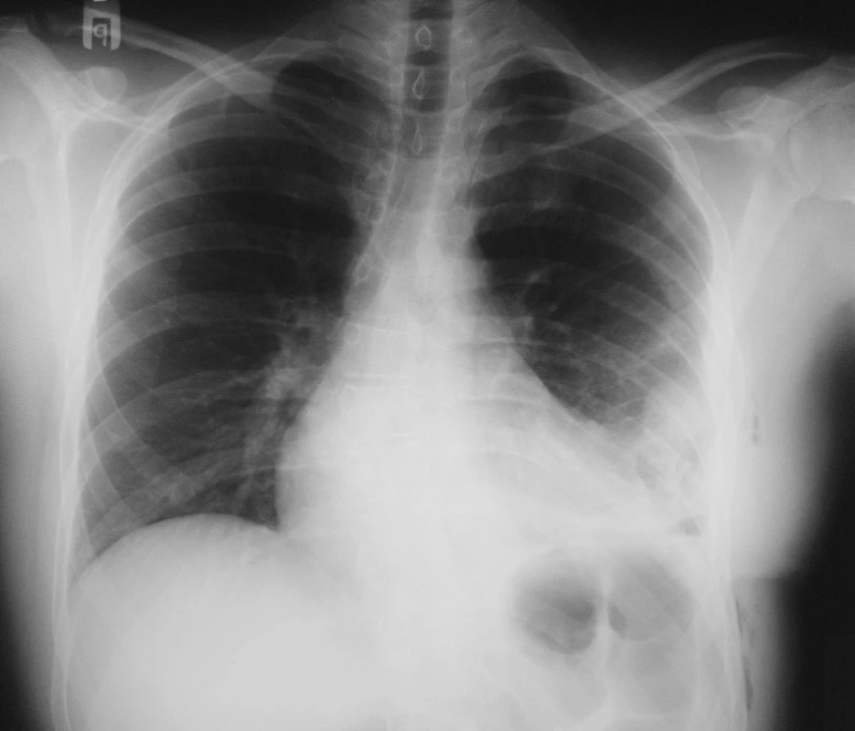 RTG hrudníku po chirurgické léčbě
Fig. 2. X-ray of chest after surgical treatment