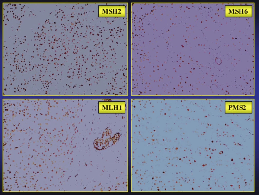 Imunohistochemický průkaz jaderné exprese proteinů MLH1, PMS2, MSH2 a MSH6 ukazující na neporušenou funkci soustavy MMR genů